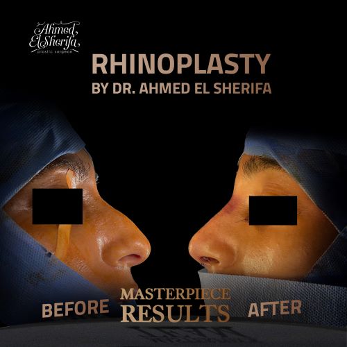 أفضل دكتور تجميل أنف في الرياض